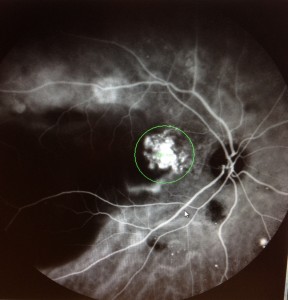 ICG angiogram by Dr Kenneth Fong